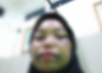 Muka Lebam, Diduga Dianiaya Sang Pacar, Mahasiswi Dipohuwato Tempuh Jalur Hukum